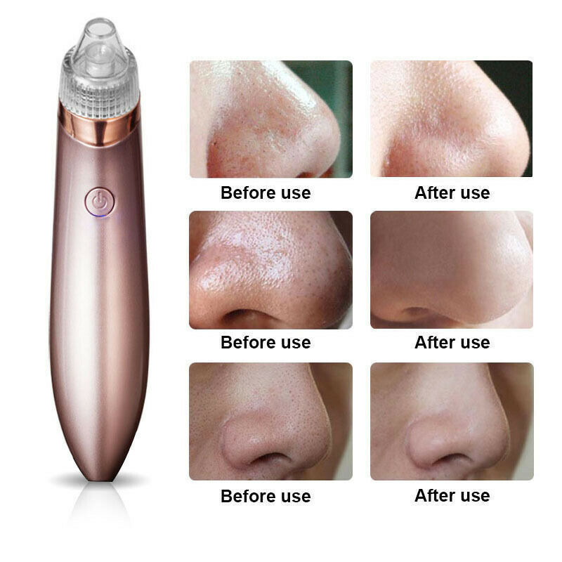 Electric Blackhead Vacuum