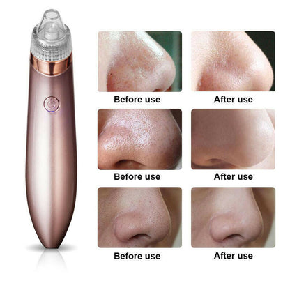 Electric Blackhead Vacuum